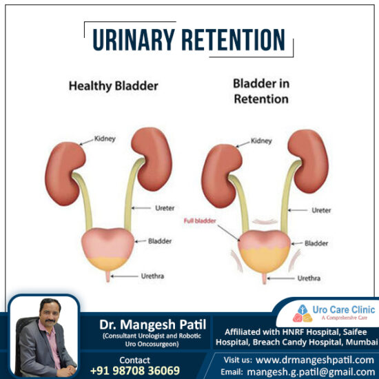 Urinary Retention Uro Care Clinic