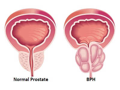 Prostate cancer treatment in Mumbai